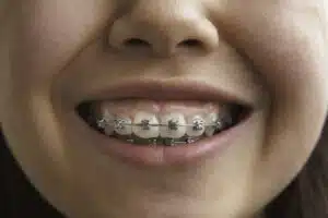 close up of a smile that has metal braces.